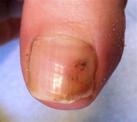 I have had this big dark brown almost black spot on my big toenail. Haematoma or Melanoma?