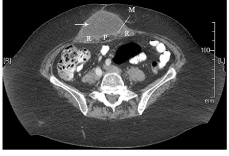 computed axial scan showing cystic seroma formation white arrow in download scientific