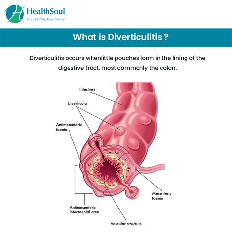 Diverticulitis – A Common Cause of Abdominal Pain after 40s – Healthsoul