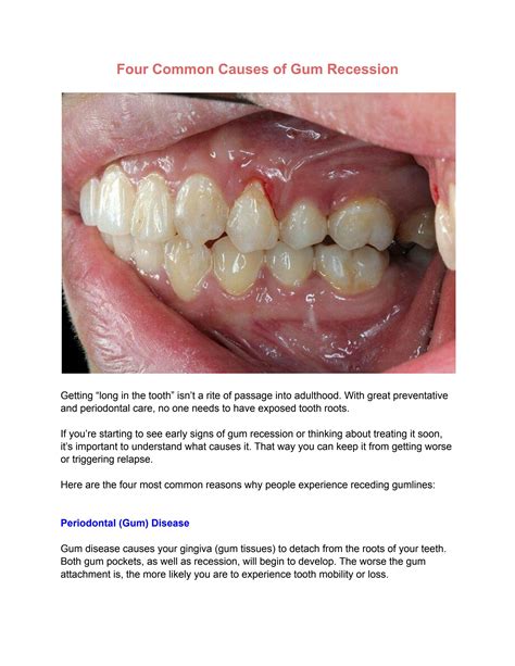 Four Common Causes Of Gum Recession By Periocenter Issuu