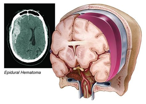 Subdural Hematoma Hematomas Neurología Causas
