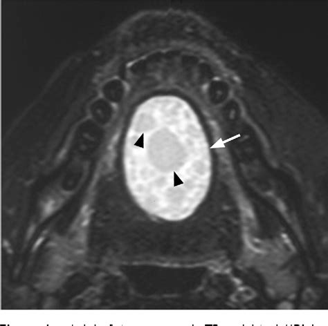 Figure 8 From Imaging Of Cystic Or Cyst Like Neck Masses Semantic