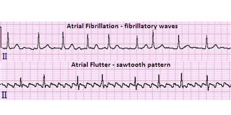 video atrial flutter vs atrial fibrillation 0 the best porn website