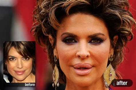 How Much Plastic Surgery Has Lisa Rinna Had Over The Years