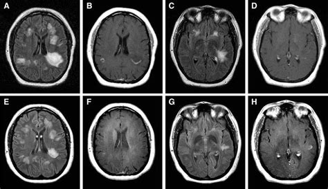 New Lesions On Early Brain Mri New Lesions On Early Brain Mri In A