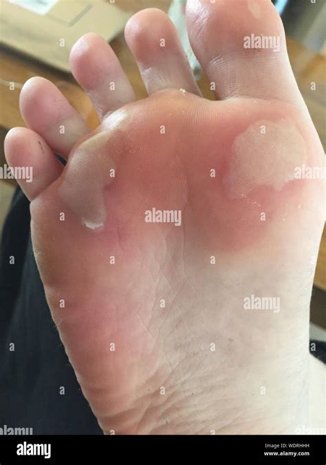 Blister Foot Hi Res Stock Photography And Images Alamy