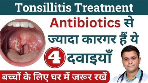 Tonsils Homeopathic Medicine Tonsillitis Homeopathic Treatment Best