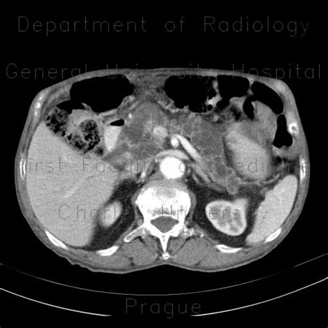 Radiology Case Intrapapillary Mucinous Neoplasm Of Pancreas Ipmn