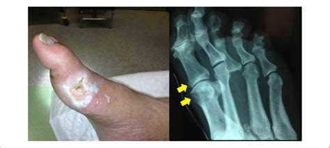 Osteomyelitis In Non Healing Diabetic Foot Ulcers A Case For Serial