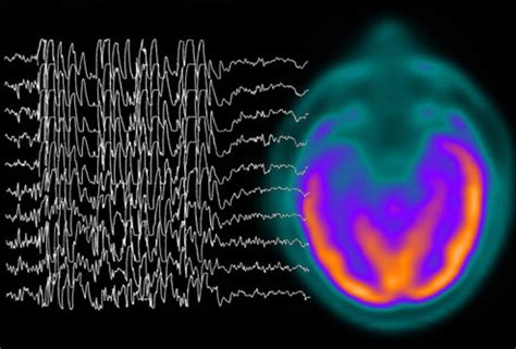 Electrical Impulse Control For Epileptic Patients Hubpages