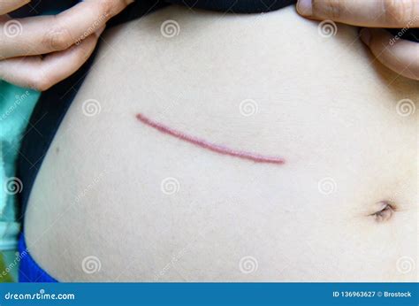 Closeup Of Woman Showing On Your Stomach With A Scar Stock Image