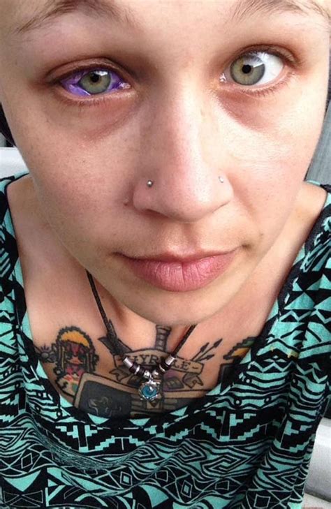 Horror Eyeball Tattoo May Ban The Procedure In Parts Of Canada