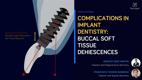 Complications In Dental Implant Dentistry Buccal Soft Tissue