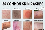 Rash: 36 Common Skin Rashes, Pictures, Causes & Treatment (2023)
