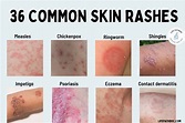 Rash: 36 Common Skin Rashes, Pictures, Causes & Treatment