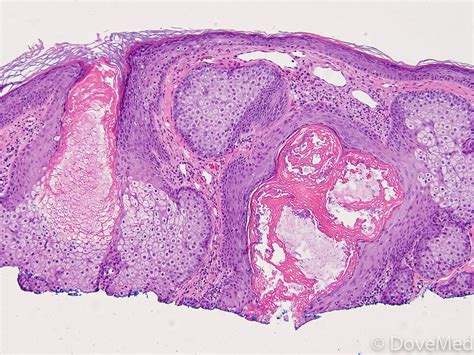 What is the most appropriate way. Sebaceous Hyperplasia