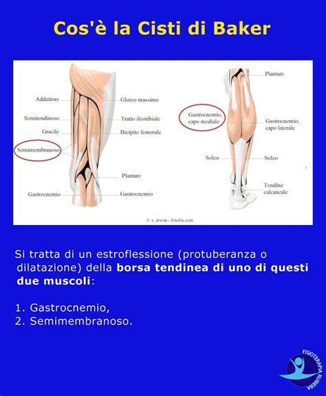 Cisti Di Baker I Sintomi E La Fisioterapia