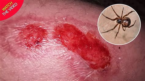 False Widow Spider Bite Explodes With Pus After Dad Pops Blister With Paper Clip Mirror Online