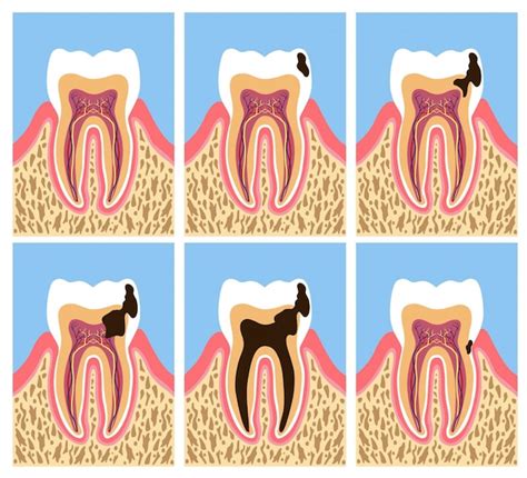 Tooth Anatomy With Dental Caries Phases Premium Vector