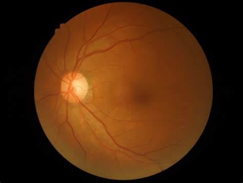 Central Retinal Artery Occlusion Net Health Book