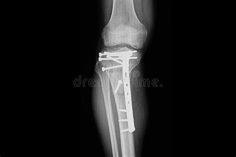 Fractured Proximal Tibia With Plate And Nails Fixation Stock Photo
