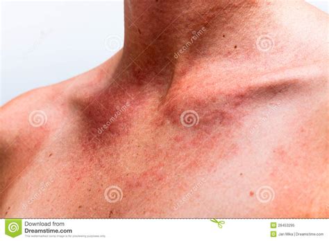 Sun Allergy Stock Image Image Of Background Neck Body 28453295