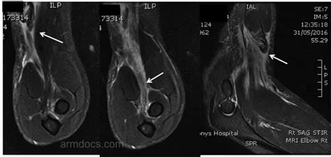 Distal Biceps Tendon Tear MRI