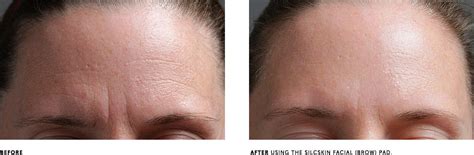 Slicskin Wrinkle Reduction Treatment Selinsgrove Pennsylvania 17870