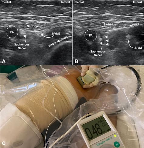 Ultrasound Guided Saphenous Nerve Block Of The Thigh