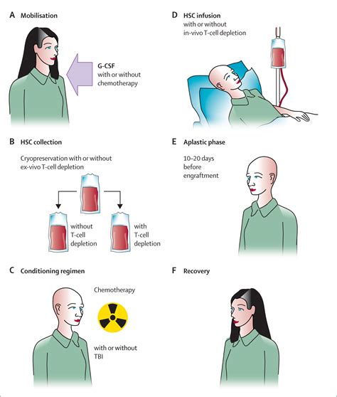 autologous haematopoietic stem cell transplantation in multiple sclerosis the lancet neurology