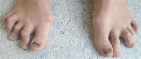 Hammer Toe Deformity Toe Conditions The London Foot And Ankle Clinic