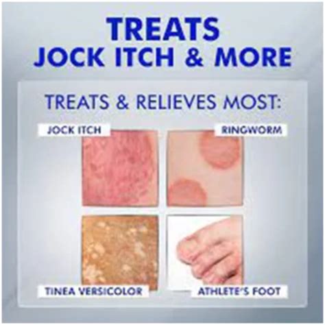 jock itch treatment in homeopathy at best price in noida id 25934284262