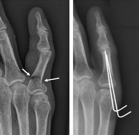 Broken Pinky Finger X Ray