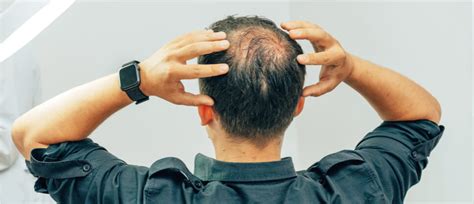Male Pattern Baldness Treatment 6 Options Health Centre By Manual