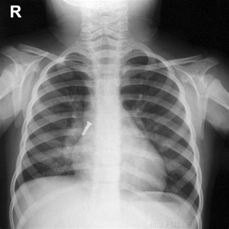 Chest Radiography For Inhaled Foreign Body Wikiradiography