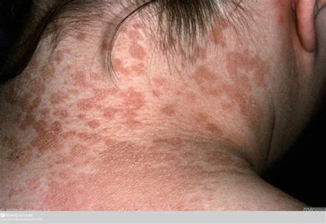 Tinea Versicolor Current Health Advice Health Blog Articles And Tips