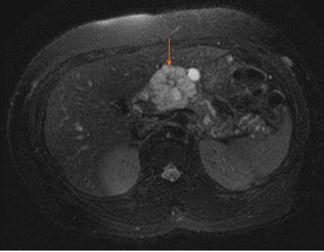 Updates In Diagnosis And Management Of Pancreatic Cysts