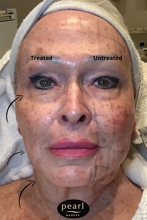 Thermage Skin Tightening Treatment Pearl Medspa