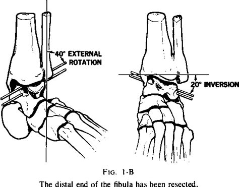 Figure 1 From The Key Role Of The Lateral Malleolus In Displaced