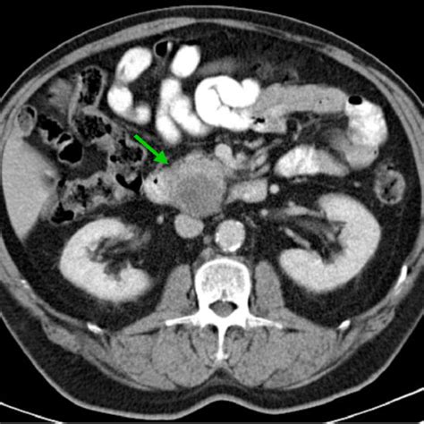 Adenomyoma Of The Pancreas Abdominal Computed Tomography Scan Reveals