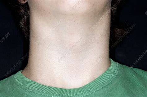 Swollen Neck In Glandular Fever Stock Image C0110448 Science