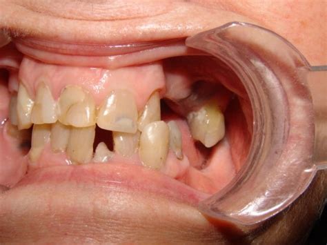 Guided Dental Implants To Dentures Barrie Dr Dove Dental Office