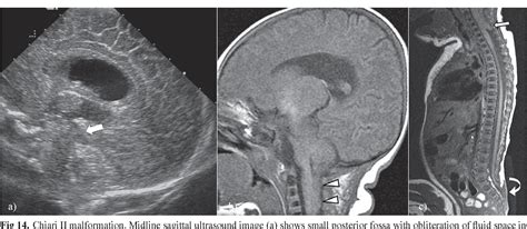 Figure 14 From Neonatal Head Ultrasound Systematic Approach To