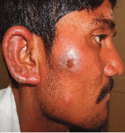 Ulcerative Erythema Nodosum Leprosum Enl On The Face Of A Male