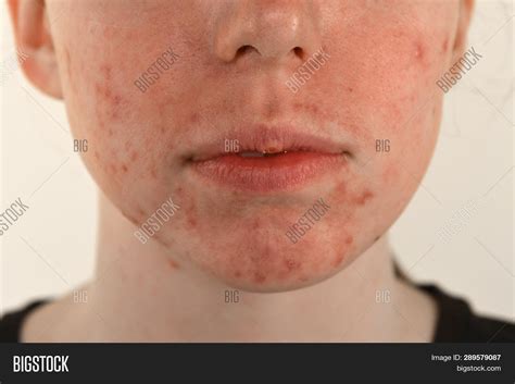 Post Acne Scars Red Image And Photo Free Trial Bigstock