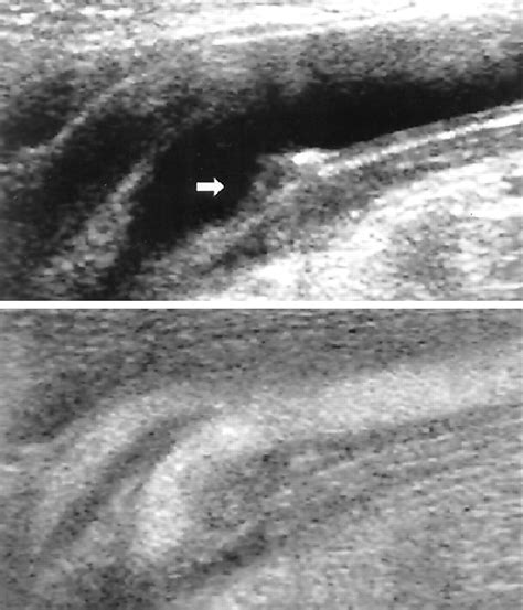 B Mode Flow Imaging Of The Carotid Artery Stroke