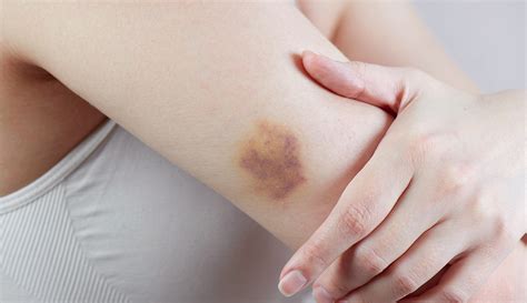 How To Heal A Bruise Fast According To A Derm Wellgood