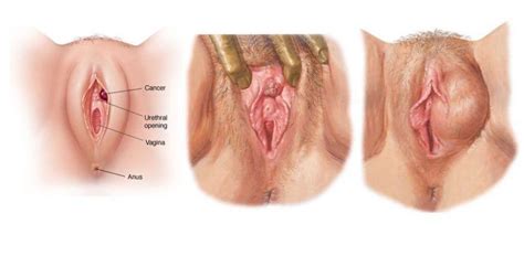 Diseases Of Vagina Hq Photo Porno Comments