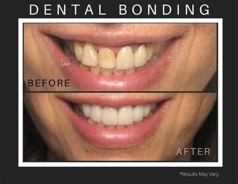 Filling The Gaps Veneers Implants And Dental Bonding Dr Kevin Sands