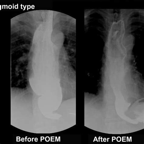 Barium Esophagogram Of Sigmoid Type Of Achalasia Before And After